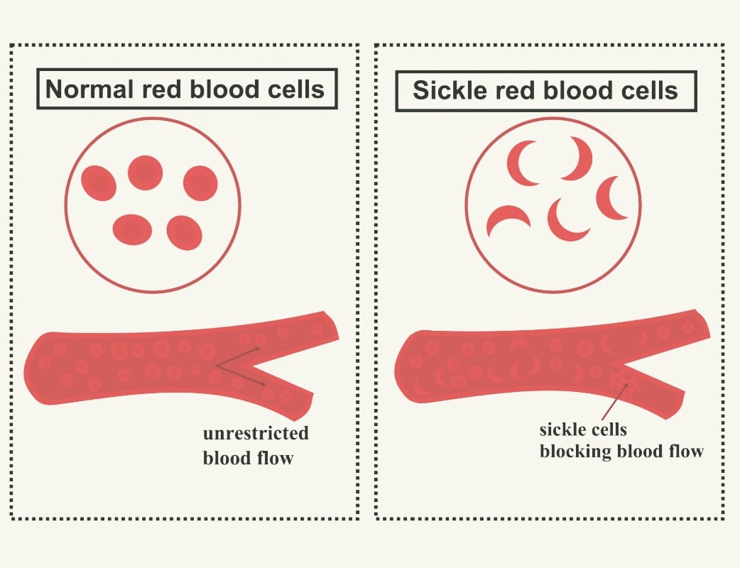 sicklecellanemi blodprov